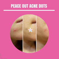 Cute printed hydrocolloid pimple patches laid out on a sheet ready to peel